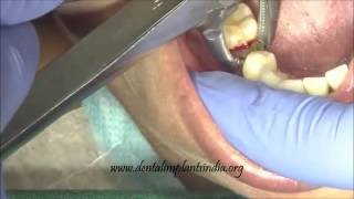 Crumbled premolar root stump extraction [upl. by Electra878]