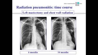 Thoracic complications of radiation therapyS Diederich International Cancer Imaging Society 2017 [upl. by Grant]