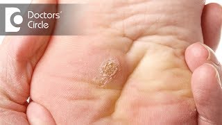 What causes of warts on hands and feet  Dr Urmila Nischal [upl. by Klina]