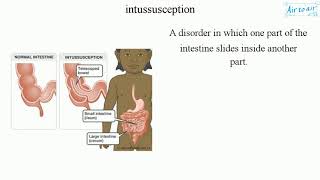 intussusception [upl. by Lenod901]