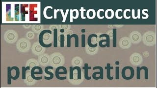 Cryptococcosis clinical presentation [upl. by Ased]