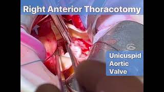 Right anterior thoracotomy AVR  Supracoronary Ao replacement [upl. by Notlil]