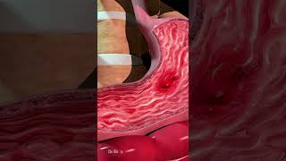 What Can Cause Stomach Ulcers Animation [upl. by Nakeber669]