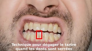 Comment enlever le tartre entre vos dents trop rapprochées pour les brossettes interdentaires [upl. by Cornelius]