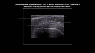 Supraspinatus calcific tendinopathy on shoulder ultrasound [upl. by Tennies]