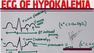 ECG OF HYPOKALEMIA  made easy  MEDICINE with DR SHAMAMA [upl. by Chaffee]