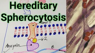 Hereditary SpherocytosisPathogenesisClinical featuresDiagnosis TreatmentMBBS Nursing [upl. by Elane]