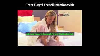 Loceryl Curanail 5 wv Medicated Nail Lacquer  Fungus Toenail Treatment Review [upl. by Sachi]