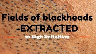 Blackhead fields extractions in HD [upl. by Tenej279]