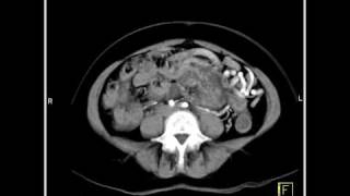 Abdomen Pancreas Pancreatic Mass 3D images demonstrate a large cystic pancreatic mass9 of 10 [upl. by Idelson]