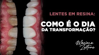 Lentes em Resina Composta Como é o dia da transformação do sorriso Por Dra Mariana Zeitune [upl. by Lacim]