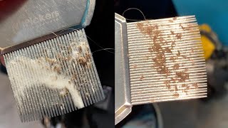 CloseUp Of Lice Infestation Removal [upl. by Lachance41]