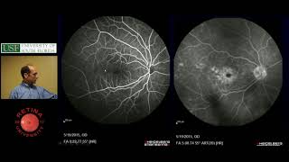 Subretinal Fluid  Ophthalmology Resident Lecture  April 2018 [upl. by Leopold]