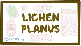 Lichen planus  causes symptoms diagnosis treatment pathology [upl. by Croteau]