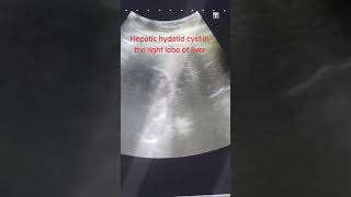 Hepatic hydatid cyst in the Right Lobe of Liver [upl. by Olivann371]