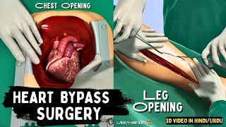 Heart Bypass Surgery  3D Video In हिन्दاردو [upl. by Amalbergas]