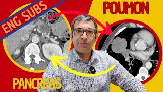 Deux cancers en même temps  Analyse dun scanner thoracoabdominopelvien [upl. by Carrillo]