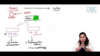 Neoplasia Diagnosis part 2  FNAC  General Pathology  DocTutorials [upl. by Tapes]