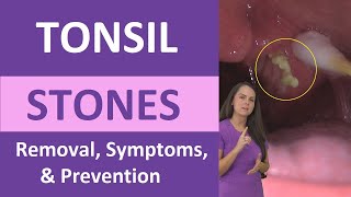 Tonsil Stones Removal Causes Symptoms Cotton Swab Treatment [upl. by Rubens83]