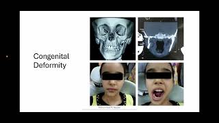 Orthognathic surgery part1 [upl. by Frodi]