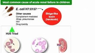 Hemolytic Uremic SyndromeHUS [upl. by Albertina]