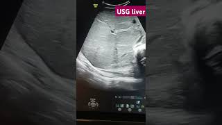 ultrasonography radiological radiology science liver infection phonk halloween beats [upl. by Nevur]