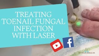 Treating Toenail Fungal Infection With Laser [upl. by Tichon]