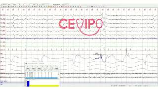 Etapa N2 a N3  Polisomnografía [upl. by Nahpos]