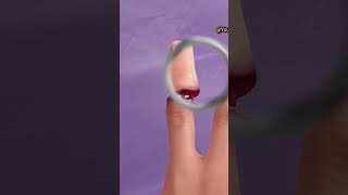 Interlocking Fingers  Finger Operation  Finger Treatment [upl. by Nadabus]