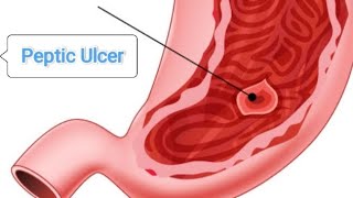 Medicine part peptic ulcer diseases By sasi sir 20810516 [upl. by Willard]