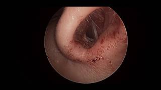 septal mucositis [upl. by Vinaya]