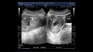 Ultrasound Video showing Incomplete abortion [upl. by Uzziel]