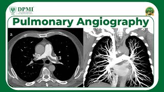 Pulmonary Angiography Indications Techniques amp Results What Is Pulmonary Angiography Used For [upl. by Ayanej592]