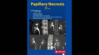 Papillary Necrosis  CT  Radiology [upl. by Gamal657]