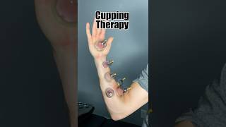 Cupping the Ulnar Nerve How to Trace and Treat Nerve Pain Effectively cubitaltunnelsyndrome [upl. by Dyl822]