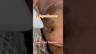 Foot corn Tretment aganikarma ayurveda panchakarmashortsyoutubevideoyoutubeshortsfootcorn [upl. by Akinoj]