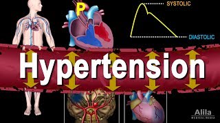 Hypertension  High Blood Pressure Animation [upl. by Nachison]