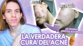 ROACCUTAN o ACCUTANE Efectos adversos como tomarla antes y despues LA VERDAD de la ISOTRETINOINA [upl. by Kendell]