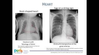 Approach to Pediatric Chest XRays [upl. by Aneeram]