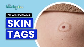 SKIN TAG  Doctors Top Tips for Preventing and Treating Skin Tags  TheTravellingDoccom [upl. by Betti]