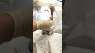 Exploding grapefruit sized sebaceous cyst popping [upl. by Monarski922]