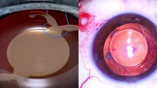 DISLOCATED TORIC MULTIFOCAL INTRAOCULAR LENS 3D ANIMATION and STEPBYSTEP EYE SURGERY [upl. by Liagabba]