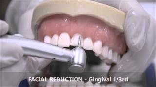 TOOTH PREPARATION FOR AN ALL CERAMIC CROWN [upl. by Gene]