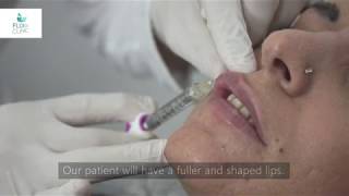 How to do Lip Fillers  Flora Clinic Istanbul 2019 [upl. by Laleb50]