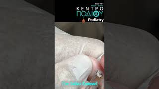 Toe Callus RemovalΚάλος κεντροποδιου kentropodiou podiatry podologia podiatrist foot corns [upl. by Beaulieu]