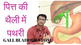 पित्त की थैली में पथरी  Gall bladder stone symptoms diagnosis treatment [upl. by Inavoig]