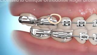 orthodontie et élastiques pour corriger une malocclusion clIII [upl. by Ahsitam540]