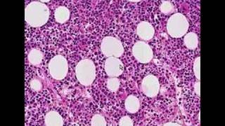 Histopathology Bone marrow Follicular lymphoma [upl. by Sidwohl248]