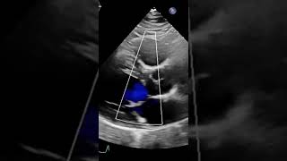 Subaortic membrane on Echoechoshortsshort [upl. by Pazit]