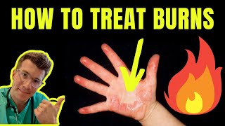 HOW TO TREAT AND MANAGE BURNS AND SCALDS  DOCTOR EXPLAINS plus first aid tips [upl. by Tennaj]